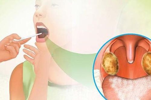 1 người tử vong do bệnh bạch hầu, Bộ Y tế yêu cầu tăng cường phòng, chống, không để bệnh lây lan trên diện rộng