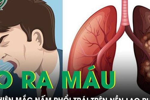 Thường xuyên ho ra máu bệnh nhân u nấm phổi bên trái trên nền lao phổi cũ