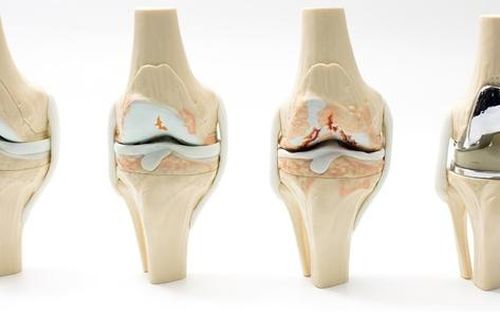 Câu hỏi thường gặp liên quan đến thoái hóa khớp gối