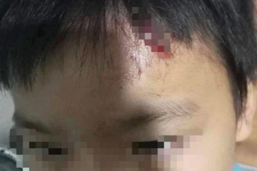 Cà Mau: Nghi mẹ kế tái diễn bạo hành con chồng