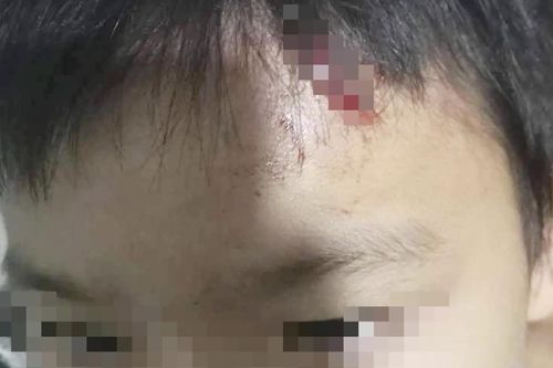 Vừa chịu án tù treo tội bạo hành, mẹ kế lại bị nghi tiếp tục đánh con rách trán
