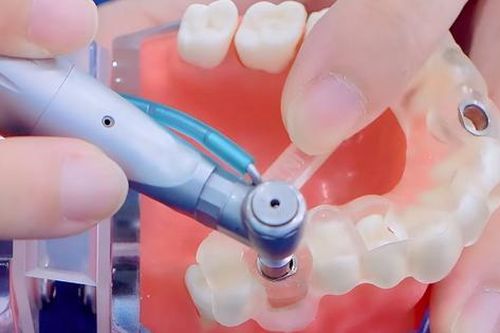 Máng hướng dẫn phẫu thuật Guideline - Bí quyết trồng răng implant an toàn, không biến chứng