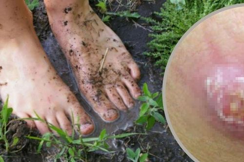 Người đàn ông nguy kịch do nhiễm 'vi khuẩn ăn thịt người'