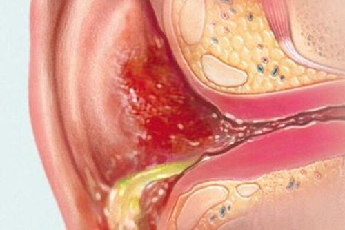 Thuốc nào trị viêm tai khi bơi?