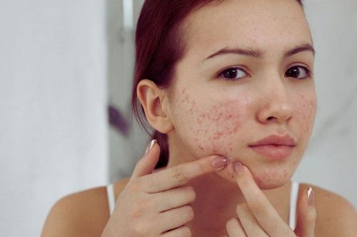 Lý do bạn dễ bị mụn trứng cá hơn người khác