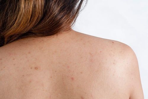 7 nguyên nhân khiến mụn lưng tái đi tái lại