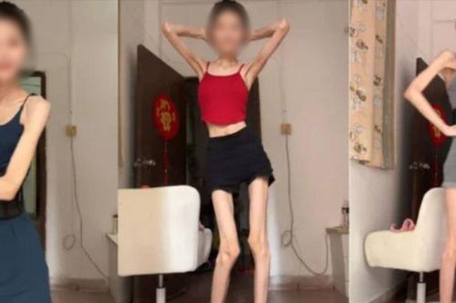 Cô gái cao 1m6, nặng 25kg vẫn muốn ăn kiêng để gầy hơn
