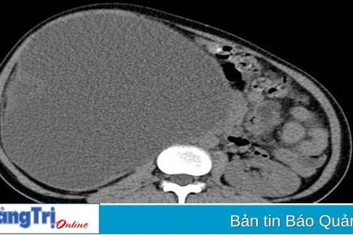 Bệnh viện Đa khoa tỉnh Quảng Trị: Thực hiện phẫu thuật nội soi cắt thận cho bệnh nhân người Lào