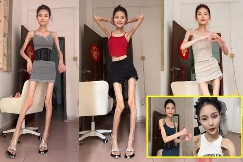 Bị gọi là Bạch Cốt Tinh do quá gầy, cô gái nặng 25kg vẫn muốn giảm cân