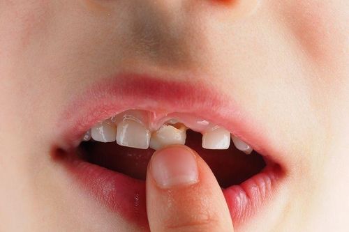 Gãy răng không nên vứt vì có thể cắm lại