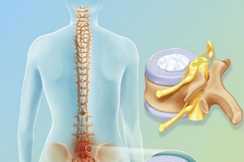 Bệnh thoát vị đĩa đệm có xu hướng 'trẻ hóa'