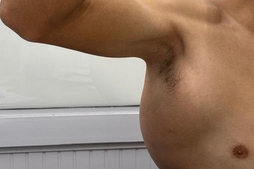 U máu: Nguyên nhân, triệu chứng, phòng ngừa và điều trị
