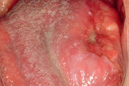 Ung thư lưỡi: Nguyên nhân, triệu chứng, phòng ngừa và điều trị