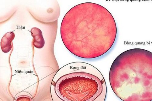 Viêm bàng quang cấp có nguy hiểm không?