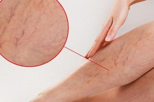 6 dấu hiệu cảnh báo suy giãn tĩnh mạch chân