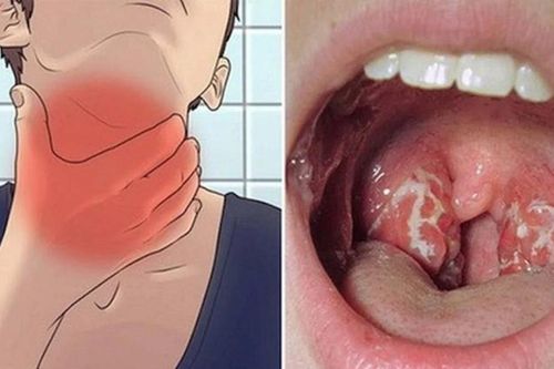 Dấu hiệu cảnh báo lây nhiễm vi khuẩn bạch hầu