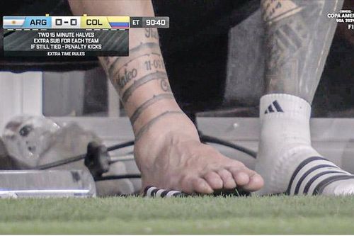 Chân của Messi biến dạng