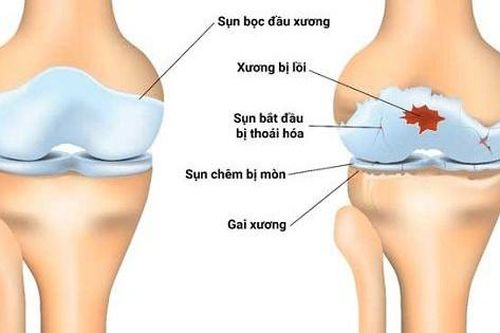 Các phương pháp điều trị thoái hóa khớp gối