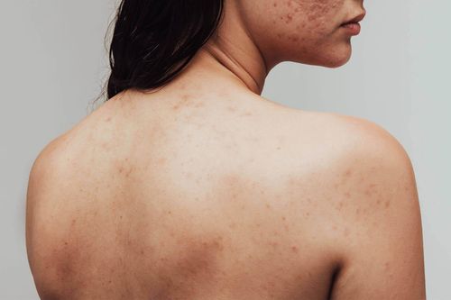 Dấu hiệu bạn cần gặp bác sĩ để trị mụn cơ thể