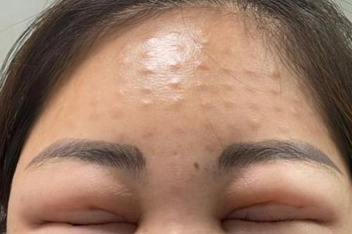 Biến chứng vì tiêm meso trẻ hóa ở cơ sở không uy tín