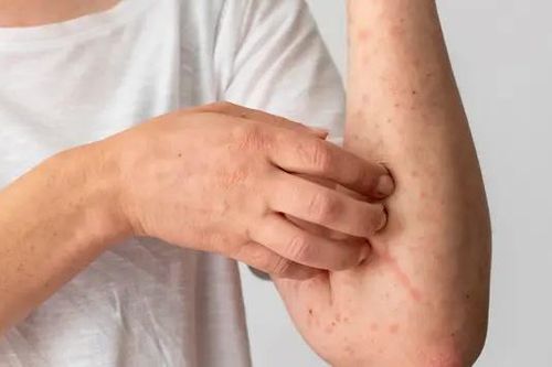 Hy vọng mới cho bệnh nhân Eczema
