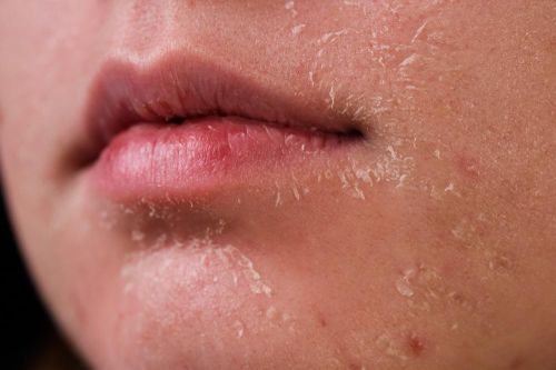 Những kiểu peel da phổ biến