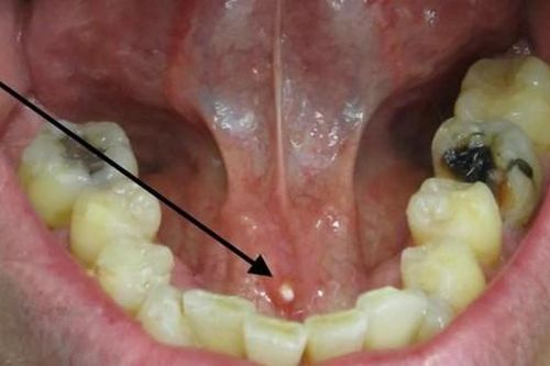 Sỏi tuyến nước bọt dưới lưỡi: Nguyên nhân, triệu chứng và cách điều trị