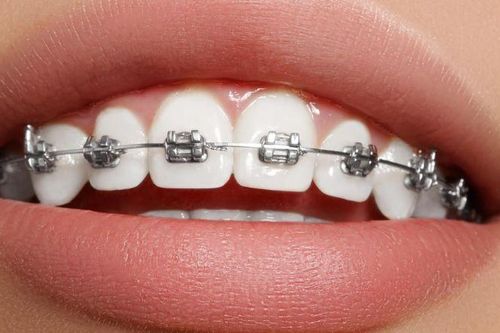 'Bắt mạch' ưu và nhược điểm các loại niềng răng trên thị trường hiện nay