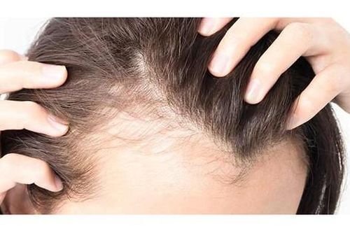 Thuốc điều trị rụng tóc do bệnh tuyến giáp