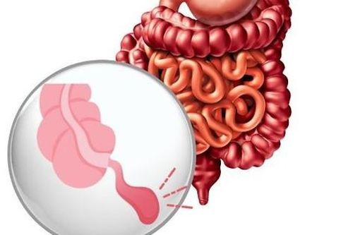 3 dấu hiệu khẩn cấp báo hiệu viêm ruột thừa
