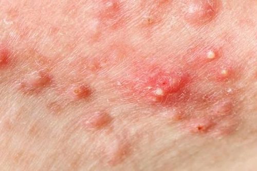 Vì sao mụn trứng cá dễ tái phát và viêm nhiễm?