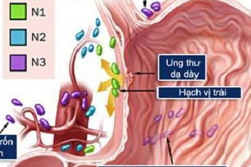 Ung thư dạ dày: Nguyên nhân, biểu hiện, cách điều trị và phòng bệnh