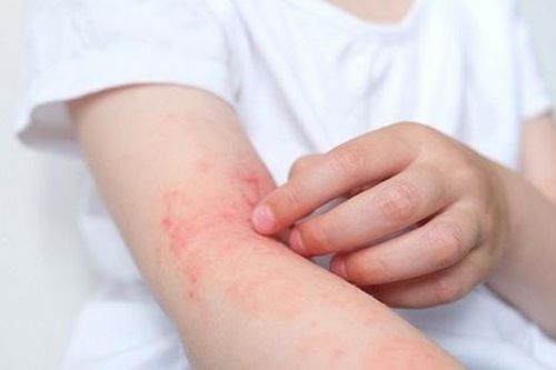 Thuốc mới trị viêm da dị ứng