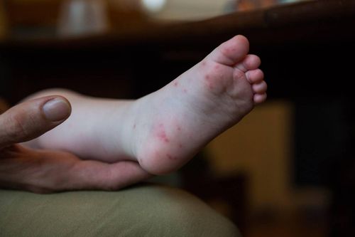 Dấu hiệu phát hiện sớm bệnh tay chân miệng