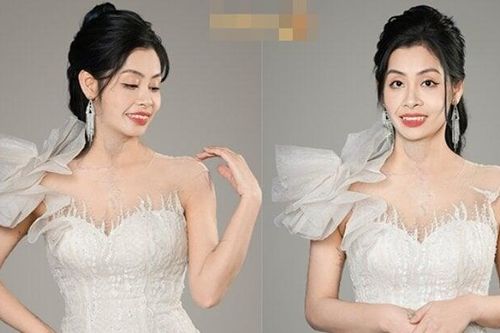 Cuộc sống mới của người phụ nữ từng bị chồng tạt axit để lại vết sẹo hơn 30cm