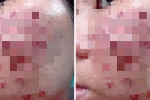 Những lưu ý của bác sĩ để hạn chế biến chứng khi tiêm meso làm đẹp