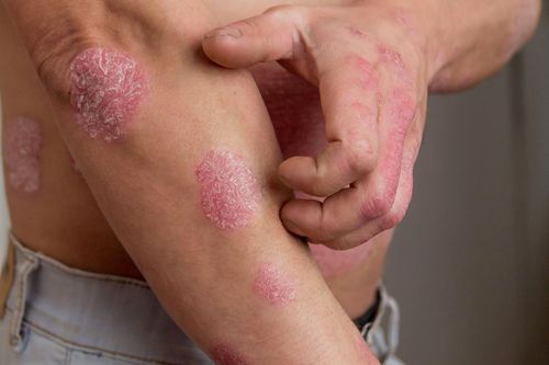 Căn bệnh khiến da chàng trai bong tróc, sần sùi như gỗ