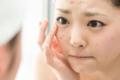3 bài thuốc chữa mụn trứng cá do rối loạn kinh nguyệt