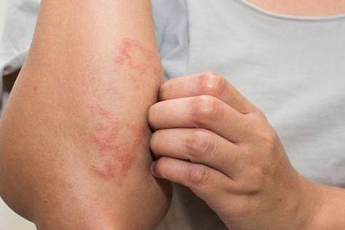 Nhận diện viêm da cơ địa ở từng độ tuổi