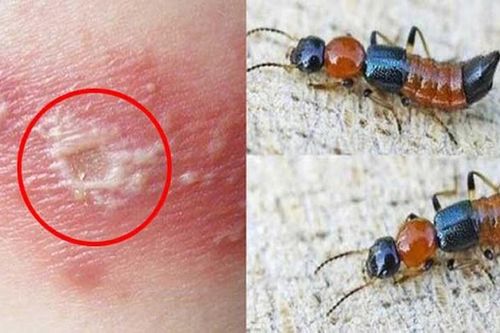Nhiều ca viêm da tiếp xúc do kiến ba khoang, cách nhận biết và xử trí đúng