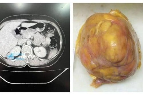 Đau tức vùng mạn sườn, đi khám phát hiện khối u cơ mỡ mạch thận siêu to