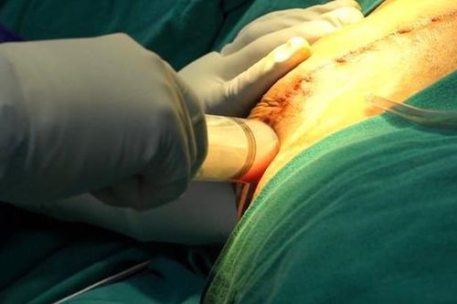 Hút mỡ bụng, gặp biến chứng nguy hiểm đến tính mạng
