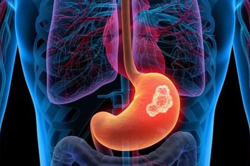 Câu hỏi thường gặp liên quan đến ung thư dạ dày