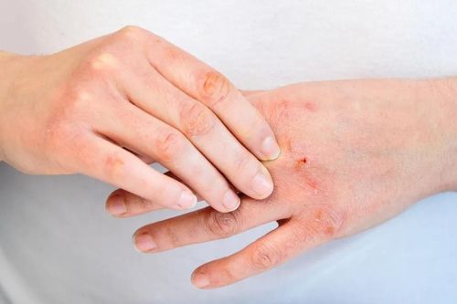 Dấu hiệu thận đang dần mất chức năng, nên đi khám sớm