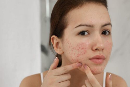 Mẹo xử lý sẹo rỗ phục hồi làn da căng mịn