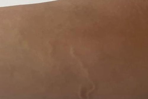 Nam thanh niên 21 tuổi nhiễm ký sinh trùng khắp người vì thói quen ăn món khoái khẩu này