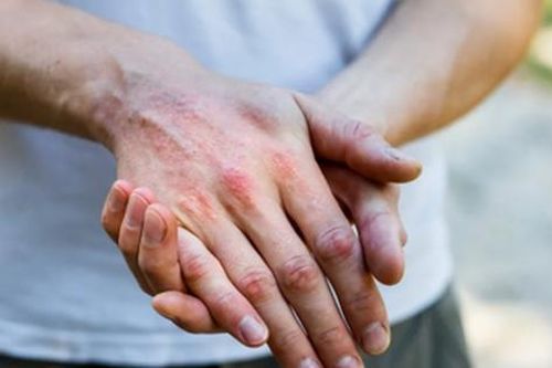 Các thuốc trị viêm khớp vẩy nến