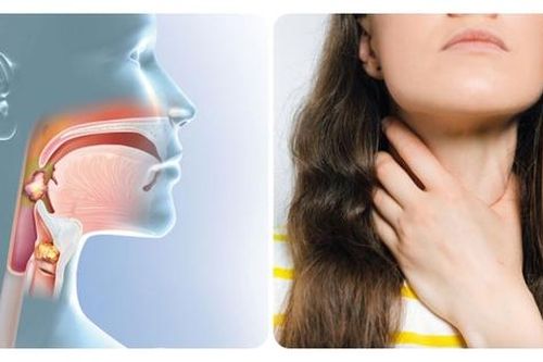 Câu hỏi thường gặp liên quan đến ung thư vòm họng