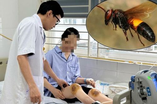 Làm theo trên mạng dùng ong chữa bệnh khớp, người phụ nữ rơi vào nguy kịch