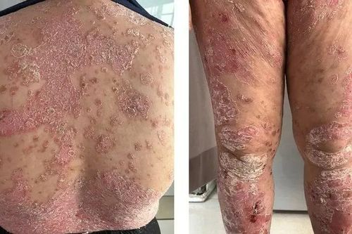 Tâm thần phân liệt do mắc vảy nến